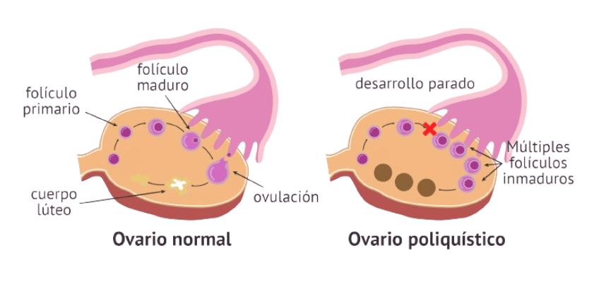 Síndrome de ovario poliquístico